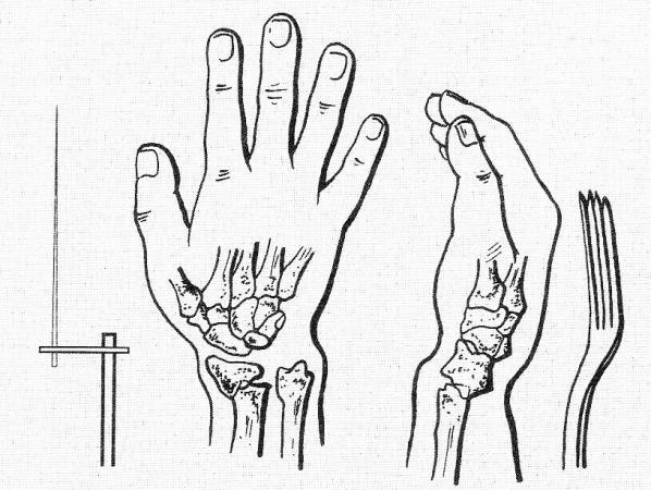 Colles (1773-1843) v roce 1814 ve své klinické práci jako zlomeninu palec a půl proximálně od kloubní plochy s dislokací periferního fragmentu dorzálně, tedy extraartikulární zlomeninu s klinicky