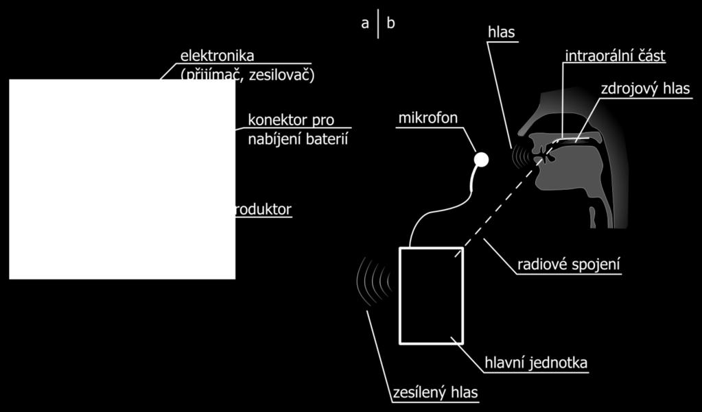 Intraorální část protézy musí být biokompatibilní a musí odolávat prostředí v ústech.