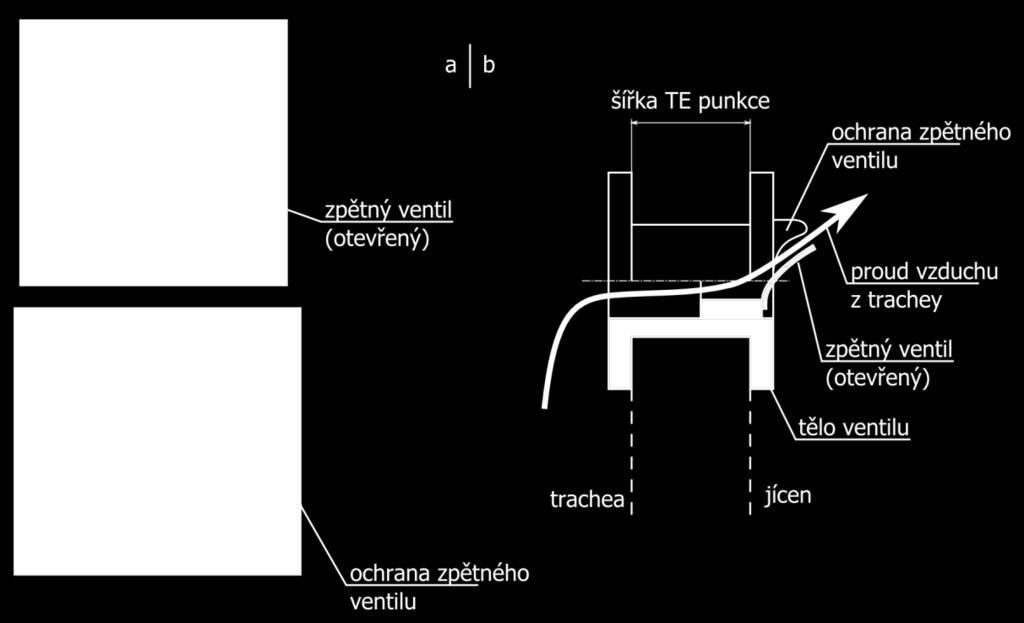 Tělo ventilu je vyrobeno z biokompatibilního lékařského silikonu, většinou technologií více komponentního vstřikování do forem (jiný materiál na tělo ventilu a na ventil samotný).