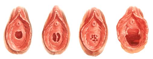 Ostium vaginae: Hymen