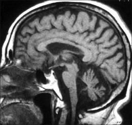 Popis CNS - části Mícha (Medulla spinalis) Mozkový kmen (Truncus encephali) Prodloužená mícha (Medulla oblongata) Most (Pons) dříve Varolův most Střední