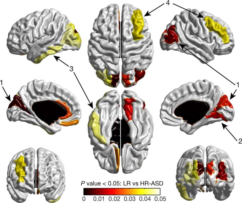 Autismus Cortical regions that show significant expansion in surface area from 6 to 12 months in HR-ASD.