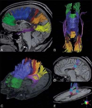 Corpus callosum - části Spojuje oblasti 1) Prefrontální 2) Premotorické a doplňkové motorické 3)