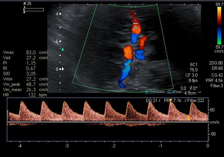 Arteriae umbilicales jsou zobrazeny pomocí barevného dopplerovského mapování na šikmém řezu pánví plodu (AU arteria umbilicalis, MM