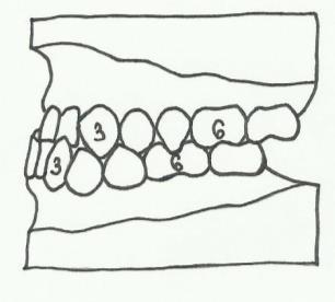 oddělení Jako hraniční případ distookluze označujeme tzv. singulární antagonismus. Je to stav, kdy se hrbolky zubů promítají přímo na hrbolky svých antagonistů.