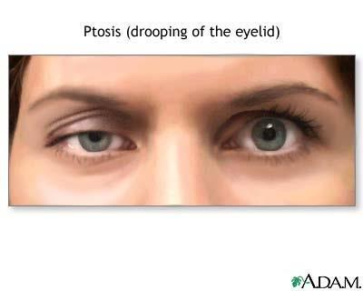 Obr. 4.3 Ptóza pravého oka Nejčastější formy ptózy: Involuční ptóza: věkem podmíněné, typicky oboustranné postižení. Dochází k degenerativním procesům aponeurózy s poruchou napětí m.