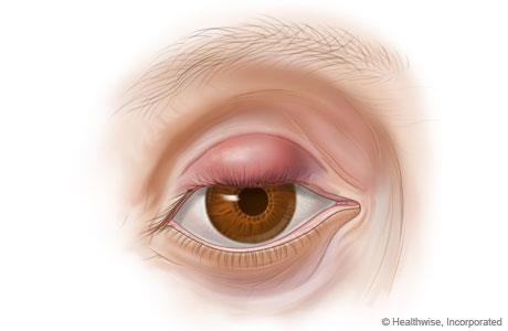 Chalazion Chalazion neboli vlčí zrno je akutní hnisavý zánět Meibomovy tarzální žlázy. (Obr. 4.