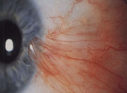 Obr. 4.13 Pterygium Klinický obraz Rozlišujeme tři klinické typy pterygia: Typ 1.: rozšiřuje se méně než 2 mm na rohovku.