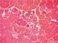 CK: 2,2 µkat/l Na obrázku imunohistochemický průkaz těžkého řetězce myosinu (heavy chain myosin fast) ve svalové biopsii. Vlákna 2. typu (hnědá) jsou v porovnání s vlákny 1.