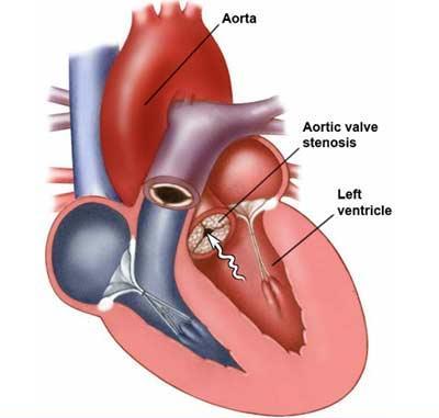 Kalcifikace anatomicky normální (senium) či