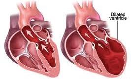 Dilatační kardiomyopatie 2-3x vyšší hmotnost srdce dilatace všech srdečních oddílů nástěnné
