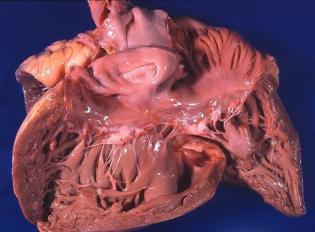 Plicní srdce Cor pulmonale hypertrofie, dilatace, příp.