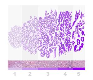 Histopatologická klasifikace nádorů GRADING Stupeň diferenciace (jak moc se nádorové buňky podobají normálním buňkám) G1: dobře diferencovaný nádor s dobrou prognózou G2: středně diferencovaný nádor