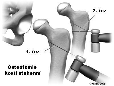 Obr. 13 - Osteotomie kosti stehenní (44). Obr.