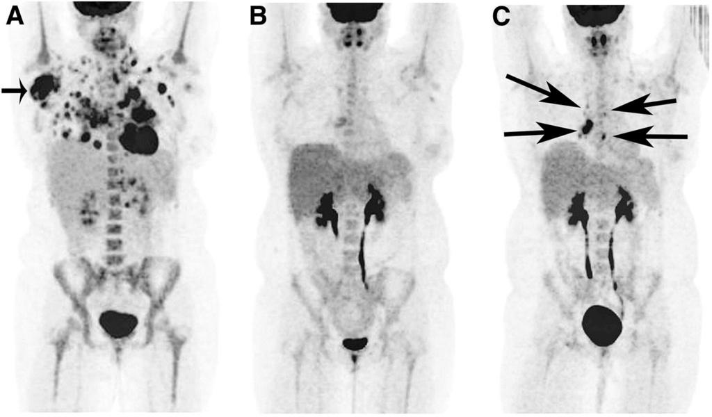 Positron emission tomography