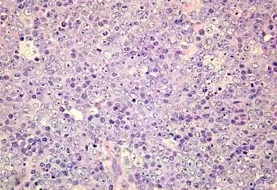 Pacient KH 1950- dg DLBCL at