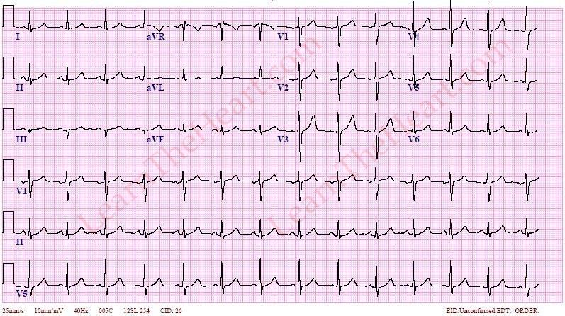 ECG