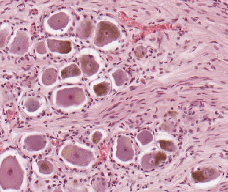 Hematogenní hemosiderin,