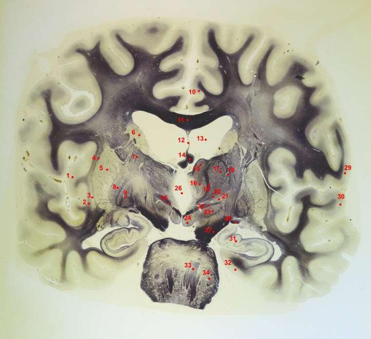 Frontální řez přes corpora mammillaria 1-insula 2-capsula extrema 3-claustrum 4-capsula externa 5-putamen 6-ncl.