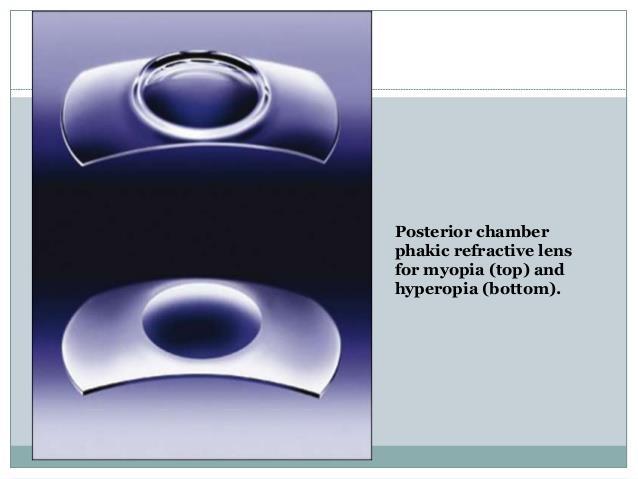 PRL-Phakic Refractive Lens Druhým modelem zadněkomorového fakického nitroočního implantátu je PRL, z anglického názvu Phakic Refractive Lens.