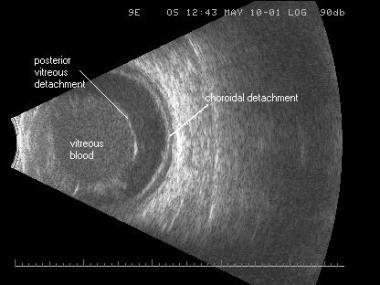 B-scan Druh ultrazvukové biometrie, která umožňuje dvojrozměrné černobílé zobrazení jednotlivých očních tkání. Poskytuje užitečné informace o stavu oční čočky, sklivce, sítnice, cévnatky a skléry.