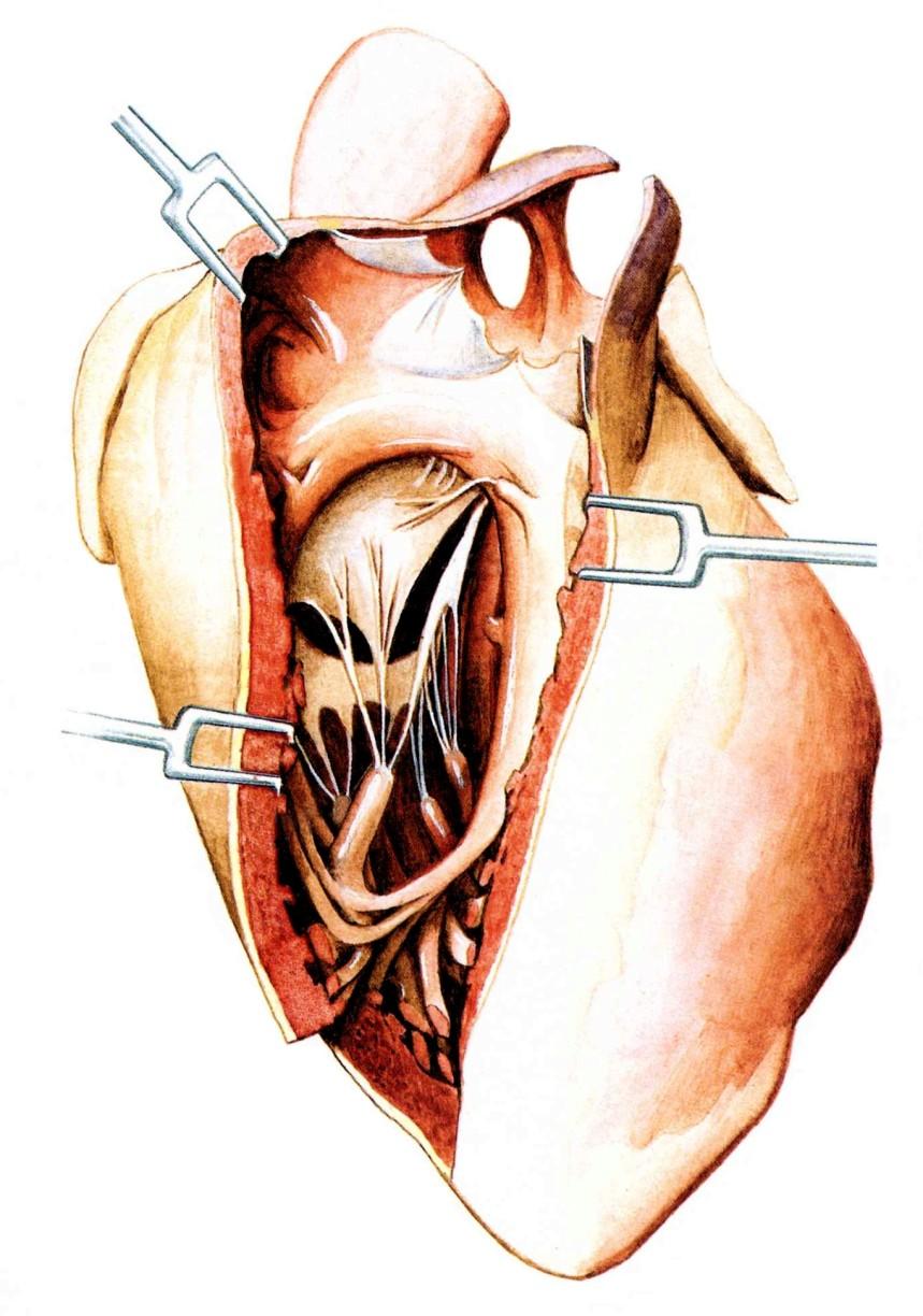 VENTRICULUS DEXTER Pars glabra conus arteriosus Ostium trunci pulmonalis