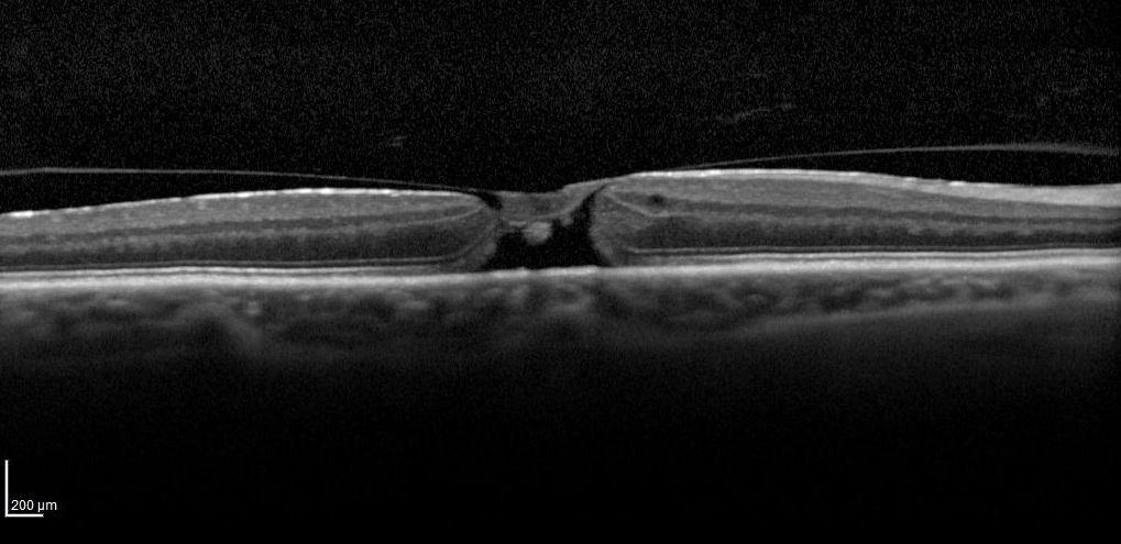 2. 3. 2. Optická koherentní tomografie Základní technikou a zlatým standardem v diferenciální diagnostice IMD je optická koherentní tomografie (OCT).