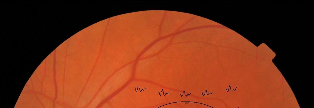 4. 3. 2. Multifokální elektroretinografie (mferg) Jde o relativně mladou vyšetřovací techniku, zavedenou do praxe v devadesátých letech minulého století.