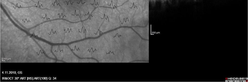 Jedná se o IMD ve třetím stádiu dle Gasse, defekt neuroretiny má v nejužším místě průměr 605 µm a zadní sklivcová membrána ještě lne kolem terče zrakového nervu (Obr. č. 33).