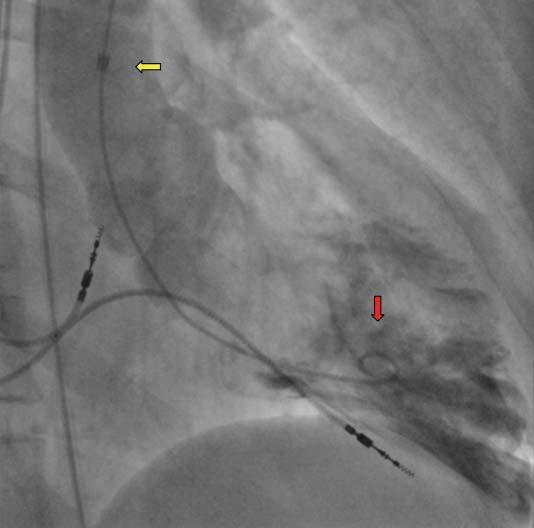 22 Obrázek 1. Do ascendentní aorty je zaveden dlouhý zavaděč (žlutá šipka), do dutiny levé komory pak koaxiálně katétr pigtail (červená šipka), kterým je provedena ventrikulografie.