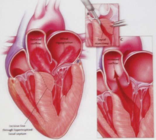 Pacientka s HOKMP, u které byla bazální část interventrikulárního septa zásobována septální větví (šipka) odstupující z proximální části pravé koronární arterie Obrázek 2.