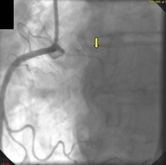 septální větve odstupující z ramus interventricularis anterior je zaveden vodič, po něm over-the-wire balonek (šipka), který je následně nafouknut (levá bočná projekce) ve výtokovém traktu LK).