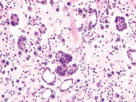 A B C D Obr. 1. A. Výrazně buněčný řez z cytobloku s četnými buňkami adenokarcinomu plic buď jednotlivými nebo tvořícími dilatované tubulární a papilární struktury (barvení hematoxylin eozin). B. Imunohistochemický průkaz TTF 1 v buňkách plicního adenokarcinomu.
