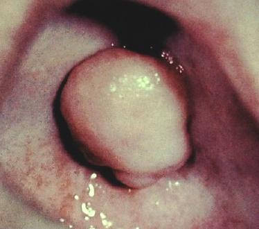 (odontogenní formy). Jejich výskyt je nejčastější u dětí kolem 14. roku a u mladých lidí kolem 30 let. Jejich lokalizace je nejčastější v horní čelisti.