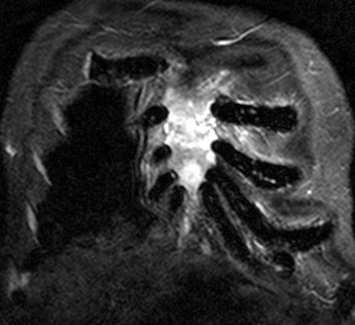 CT vyšetření osteolytická ložiska