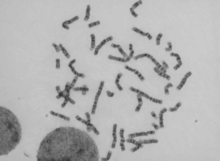 Stanovení karyotypu plodu (ověření přítomnosti / nepřítomnosti VCA) INVAZIVNÍ METODY PRENATÁLNÍ DIAGNOSTIKY 1)