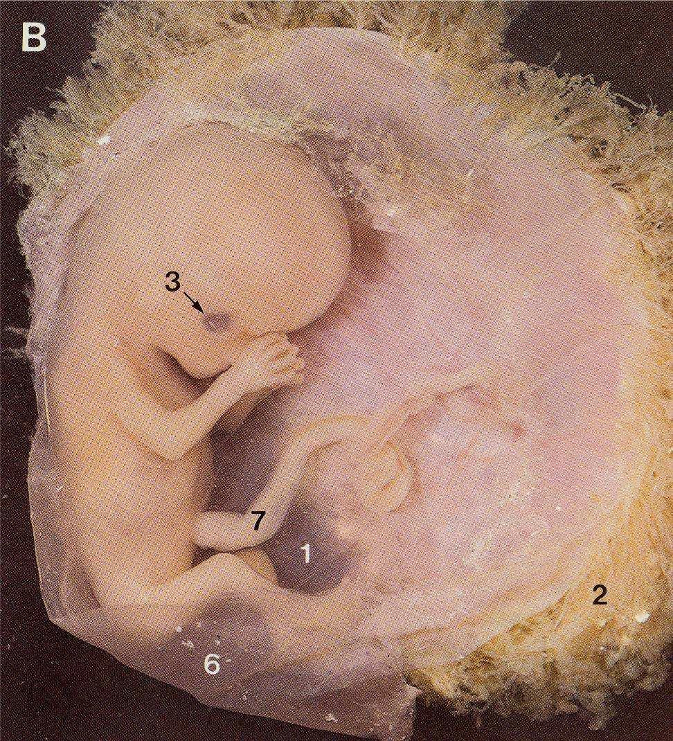 choriových klků (chorionic villi