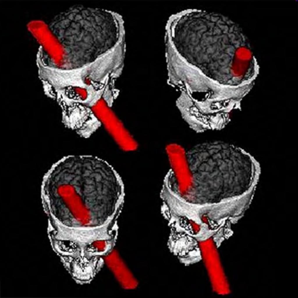 PHINEAS GAGE Pacient Phineas Gage, bilaterální poškození PFC kovovou tyčkou (1948) - dlouhodobá paměť, řeč a motorické funkce zachovány, ale narušení jeho osobnosti cholerický, netrpělivý,