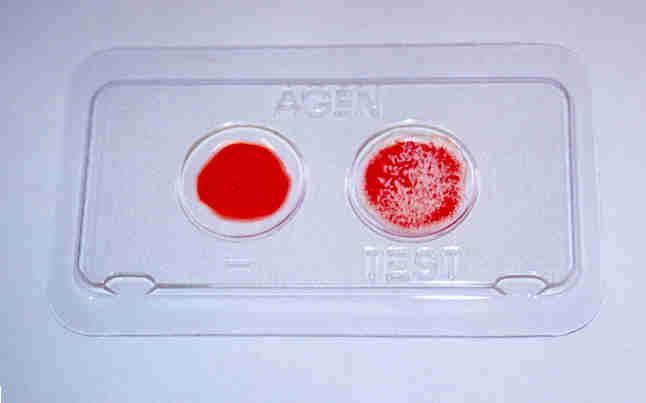 ŽTE / D-Dimer Při ŽT nebo PE je vysoce zvýšena koncentrace štěpných produktů fibrinu D-dimeru v krvi. Negativní test pomáhá vyloučit dg. ŽTE V laboratoři kvant.