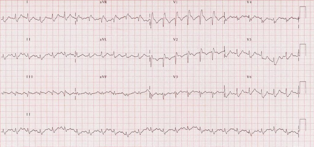 EKG Sinusová tachykardie