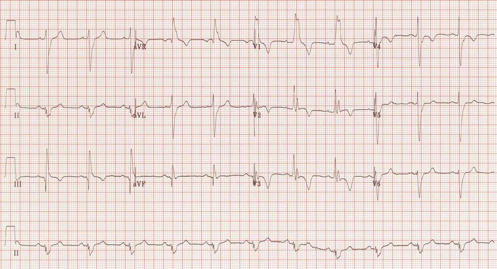 EKG RBBB SIQIII