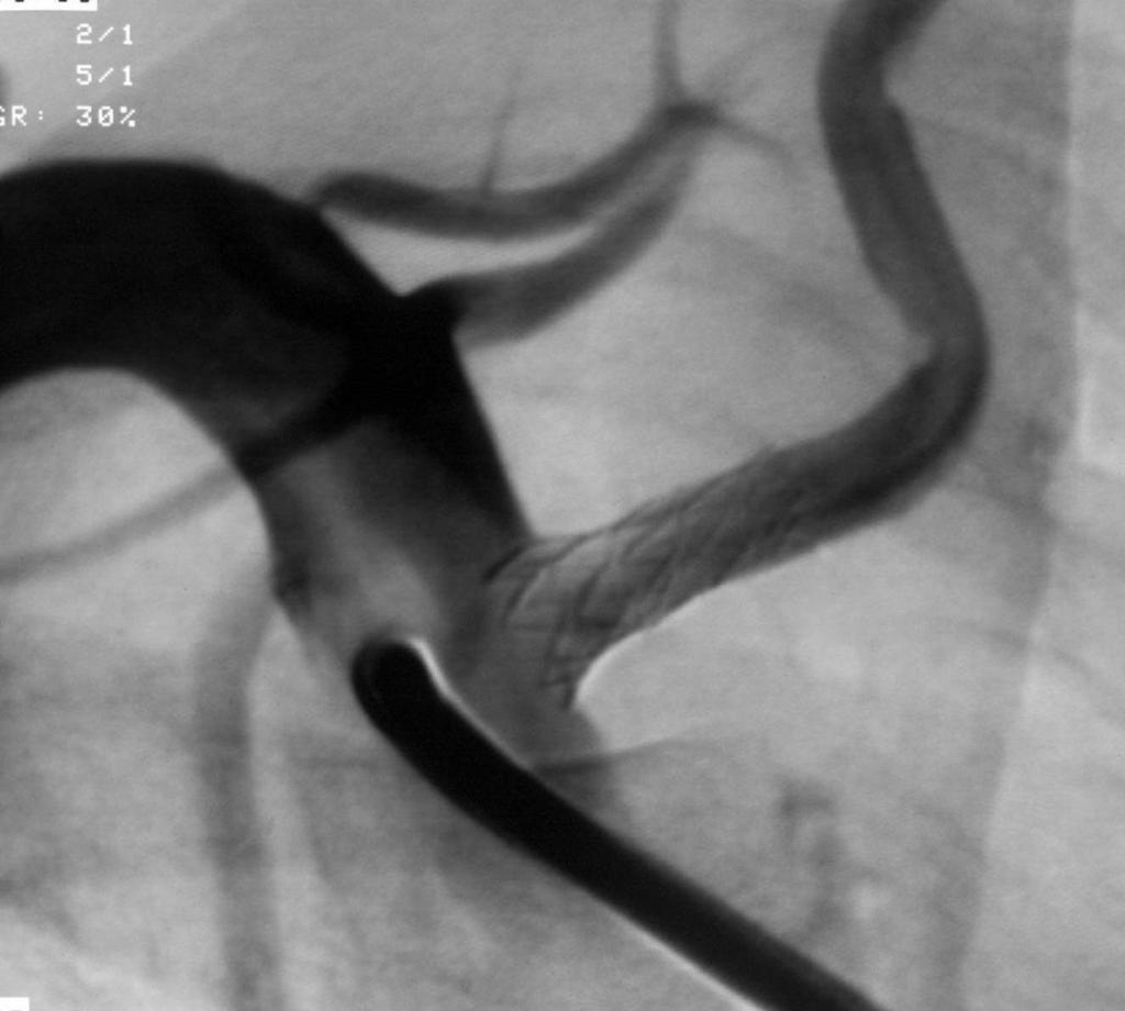 Obr.4: Angioplastika