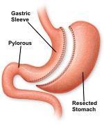 Obr. č. 1 Adjustabilní bandáž žaludku Efthimiou Bariatrics, 2013 Sleeve gastrektomie (viz Obrázek č.