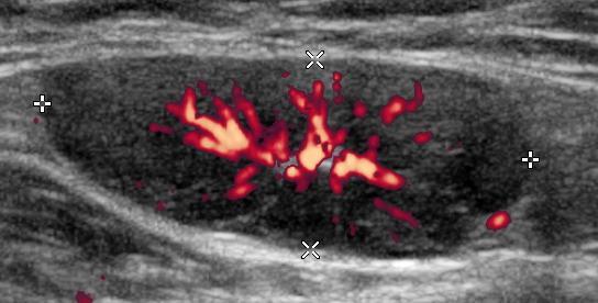 Tab. 9 Histologické nálezy benigních lymfadenopatií Histologický nález N % Nespecifické reaktivní změny - sinusová histiocytóza, kortikální a parakortikální