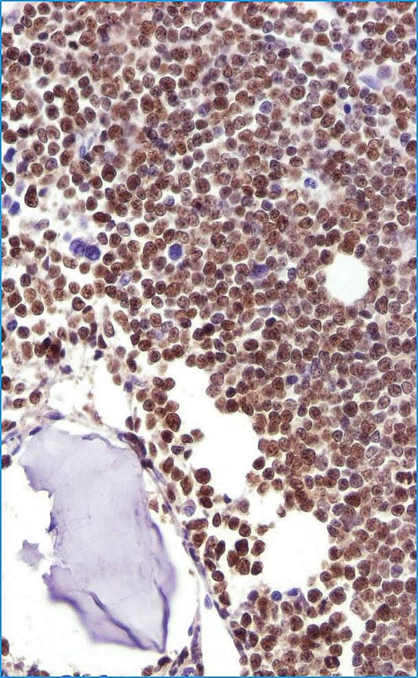 Akutní B-lymfoblastická leukémie nejčastější malignita dětí (kolem 4.