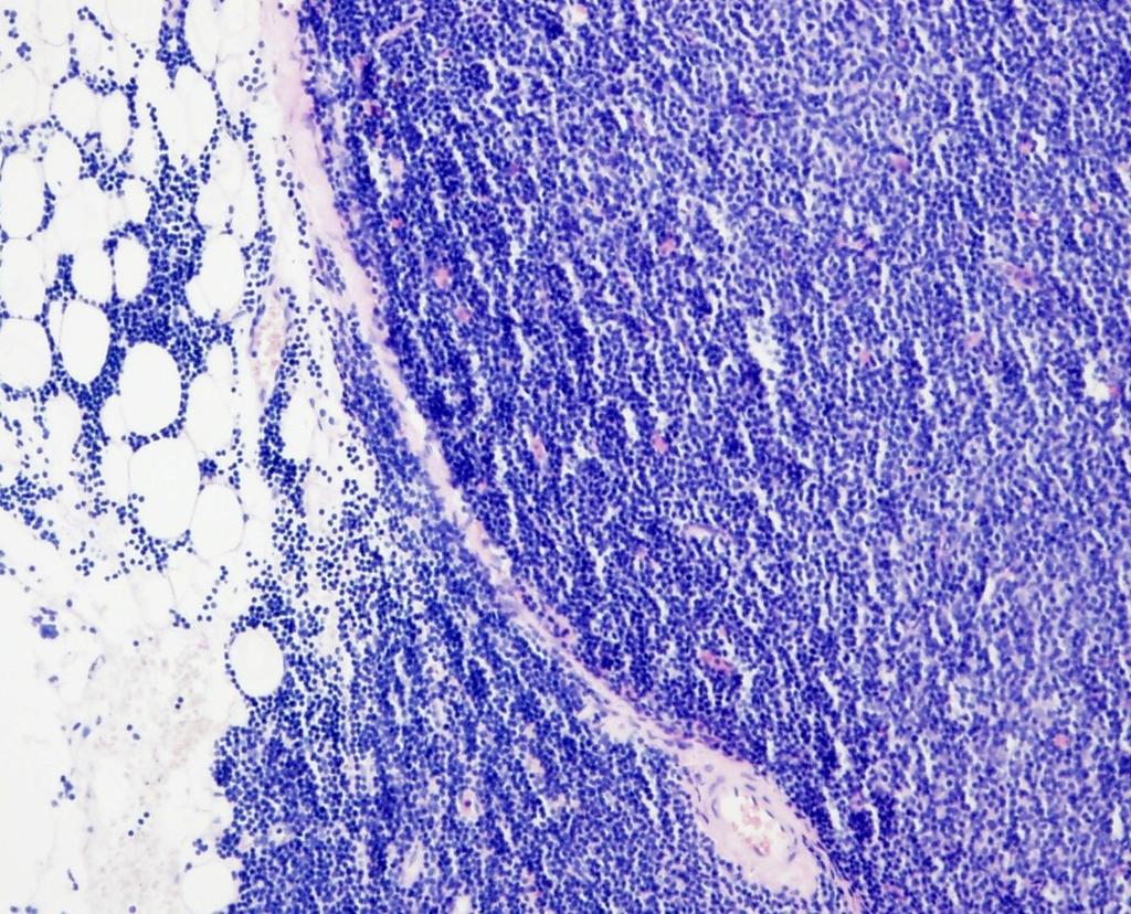 CLL/SLL nejčastější leukémie dospělých