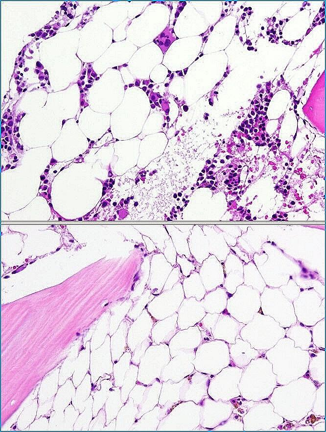 Aplastická anémie v kterémkoli věku (etiologie vrozená i získaná ) periferní krev: pancytopenie (celkový útlum krvetvorby) KD: výrazně hypocelulární myelopoéza (krevní elementy