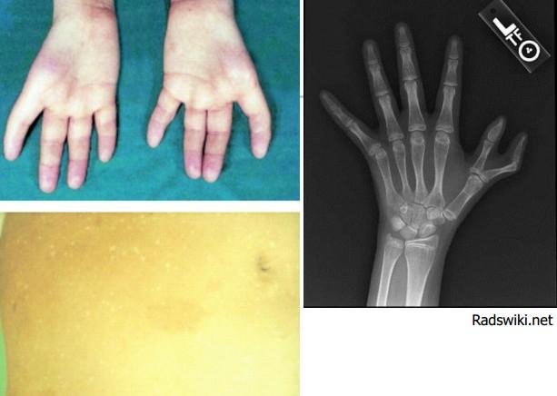 Fanconiho anémie velmi vzácná, o něco častější u Aškenáziho Židů periferní krev: progresivní pancytopenie KD: progresivní hypocelularita často +malformace skeletu a parenchymových