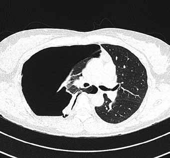 Obr. 2. HRCT plic, transverzální řez: pravostranný tenzní pneumothorax s přesunem mediastina doleva Fig. 2. HRCT of the lung, transversal image: tension pneumothorax on the right side with mediastinal shift to the left Obr.