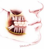 nemoci ústní sliznice, rtů a jazyka - zánět 3.